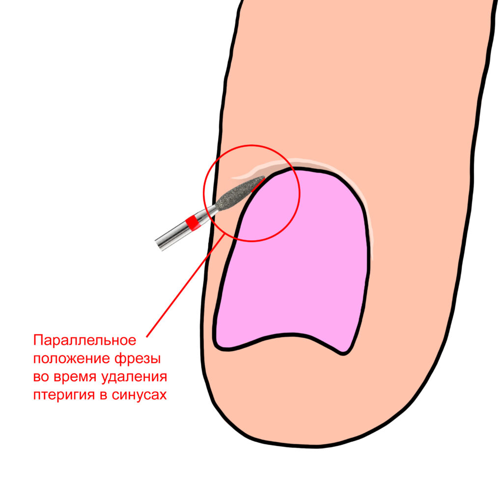 Положение фрезы во время удаления птеригия